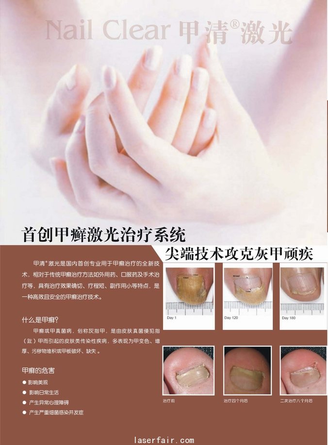 nailclear甲清激光治疗系统